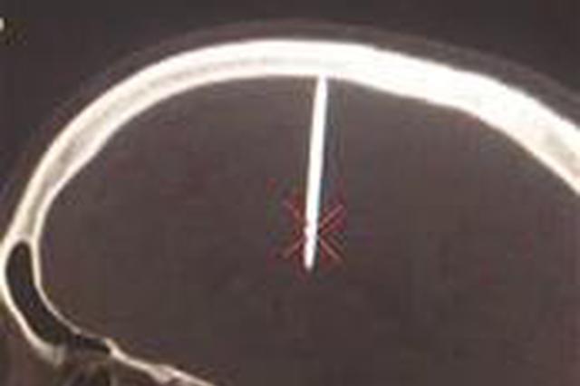 男子头疼到医院检察 发现头中有根48毫米长钉子