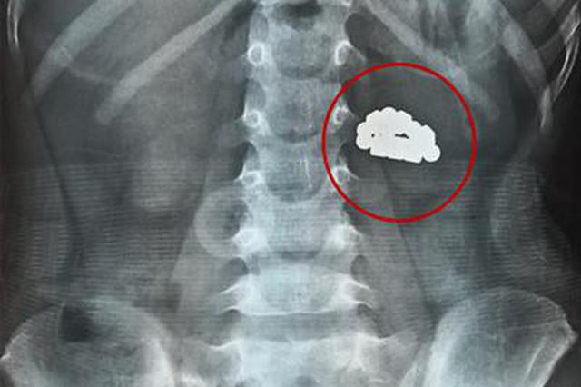X片显示5岁男童腹中有小蛇 手术取出竟然是12颗磁铁