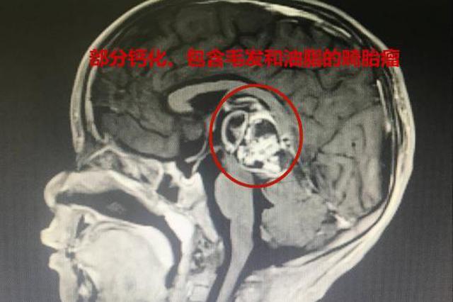 5岁男童脑里长头发 原是生出“畸胎瘤”