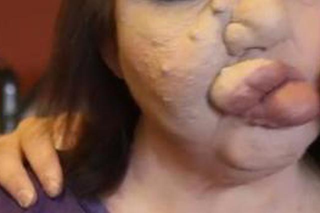 孕妇嘴唇发痒被手挠破 一个月后嘴唇外竟挂个肿瘤