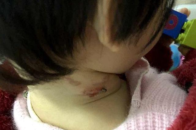 天降烟头烫伤2岁女童 母亲挨户查找无人承认