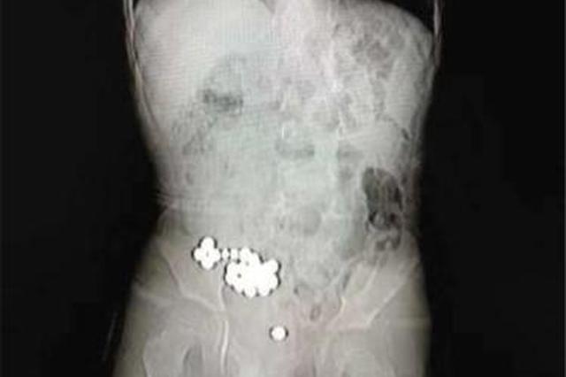 4岁男童误吞20颗磁力珠 小肠“吸”成一团多处穿孔