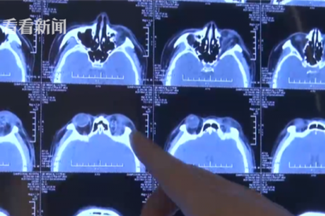 小伙醉后摔倒失明 医生看呆：整个眼球都摔没了