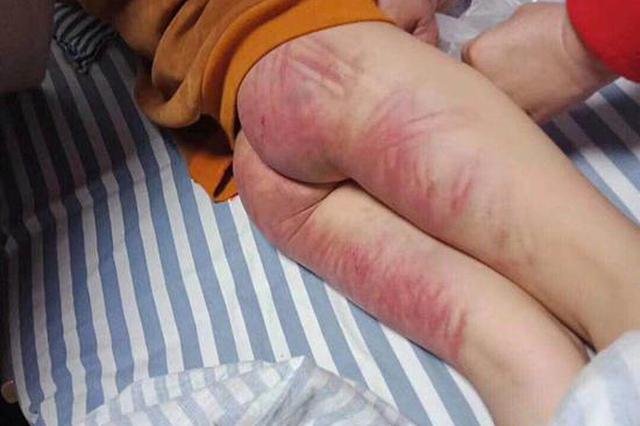 大丰一父亲将8岁儿子打得伤痕累累 曾将女儿扔进水塘