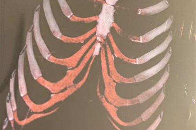 女孩南京美容遭奇葩手术:肋部划个口子就当取了肋骨