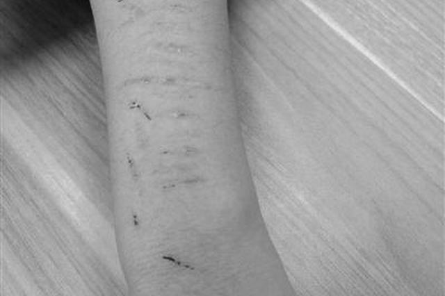 江苏14岁女生将自己划得伤痕累累 原患双相情感障碍