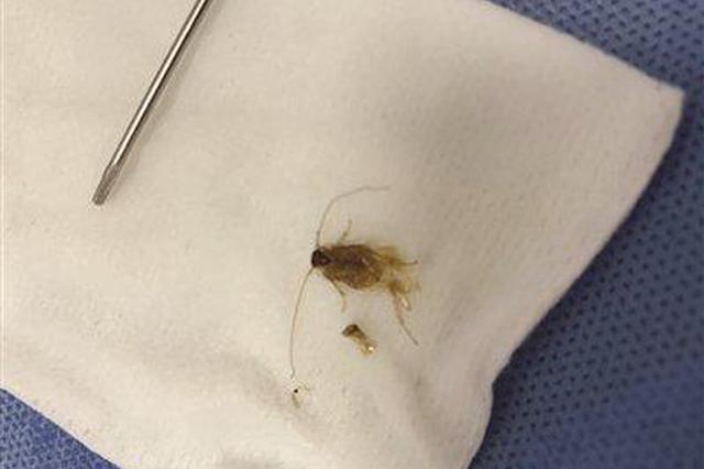 小姐姐马尔代夫度假 五天后耳内取出一只“小强”