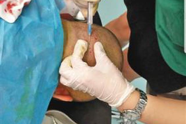 探访植发3天速成班：练2小时就手术 盐水当培养液