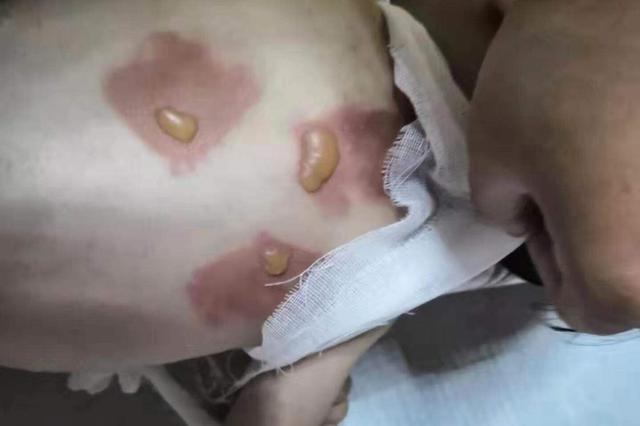 江苏6儿童敷“三伏贴”出现不良反应 涉事医生被指非法行医