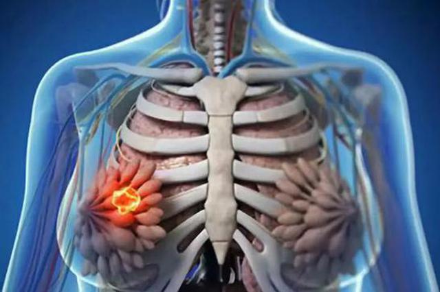 男性乳腺癌患者死亡率高于女性，或与筛查缺位、生理差异相关