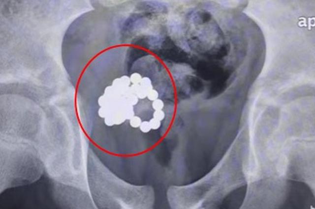 两名11岁男童将磁力珠塞入尿道 专家：儿童两性教育待加强