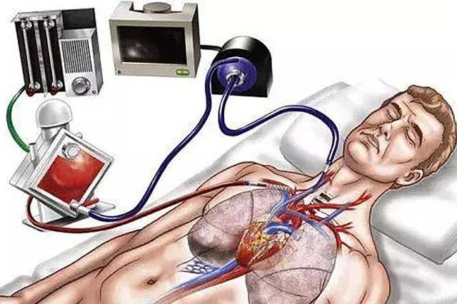 ECMO在救治危重症患者的效果如何？军队专家回应