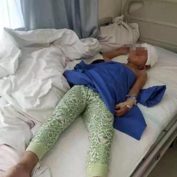 7岁男童被自家牧羊犬撕脱头皮 事发时正看大狗打架