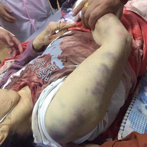 八旬老人遭保姆毒打 警方：已拘留保姆并立案调查