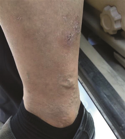 屠宏征的“病腿”。