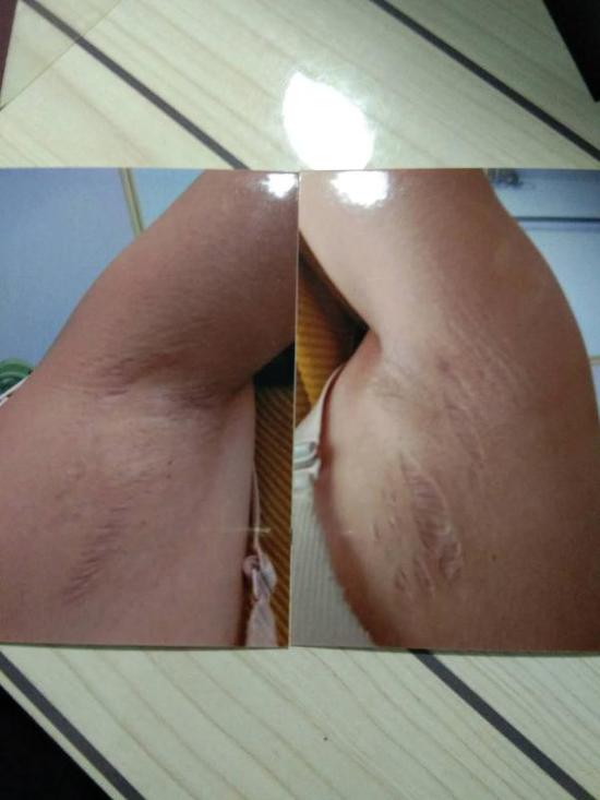 女子得“怪病”后指前夫对其注射激素 警方已介入