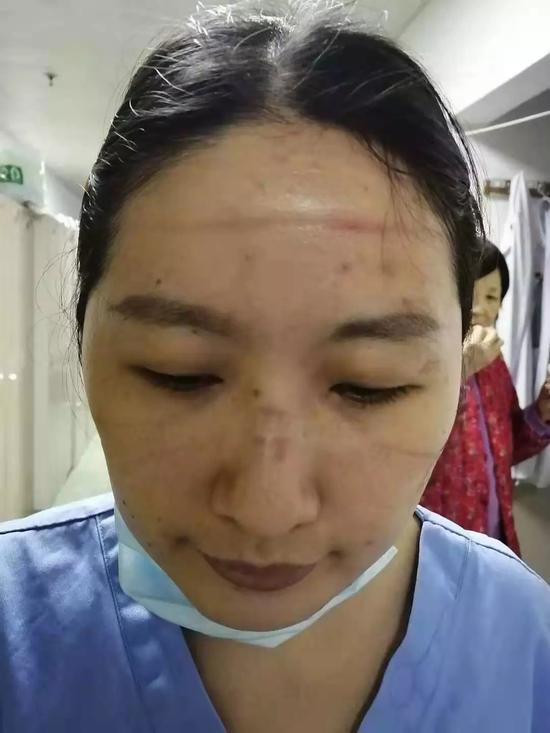 秦艳萍的脸被防护用具勒出深深的印记