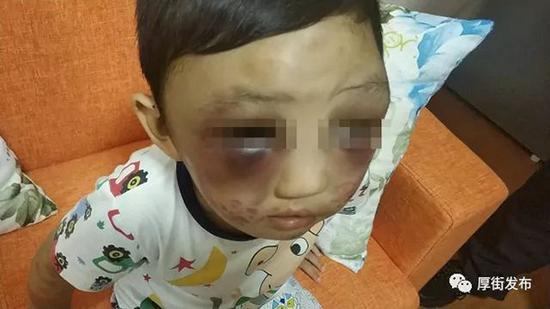 4岁男童遭单亲母亲虐待 全身多处受伤生殖器被打肿