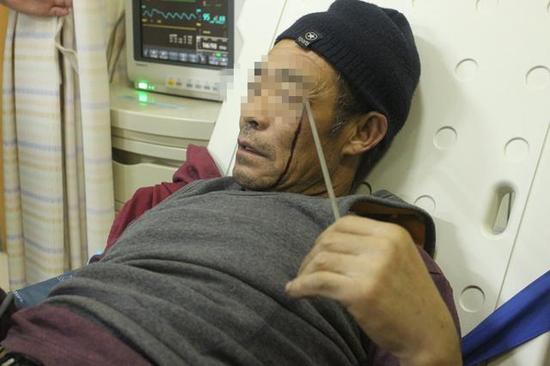 男子梯上坠落焊条插入头部 消防员紧急抢险救