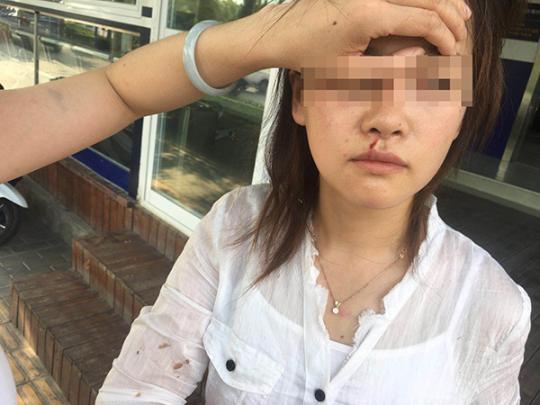 鹿女士嘴唇及眼底被打出血,脸上也有抓伤。当事人供图