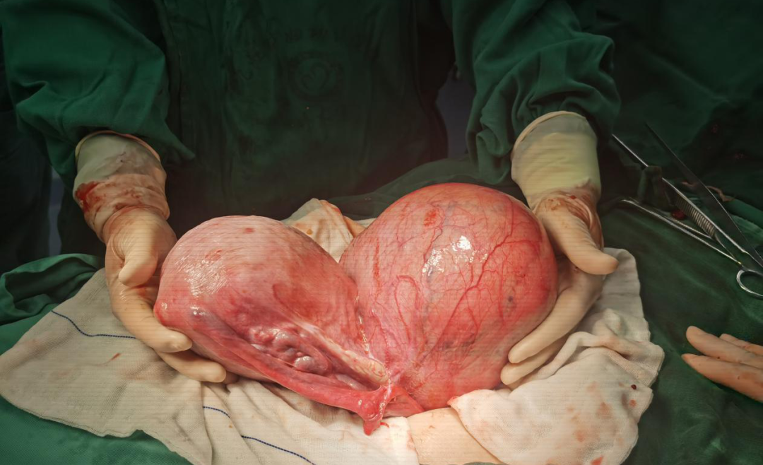 剖宫产遭遇2.2公斤巨大子宫肌瘤!