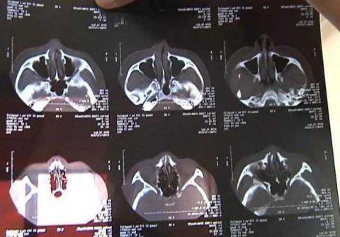 女子小区内散步祸从天降 竟被一片落叶砸到骨折