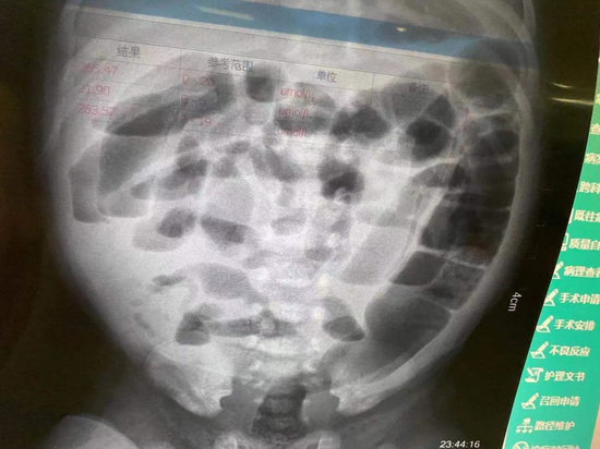 腹片显示为肠梗阻