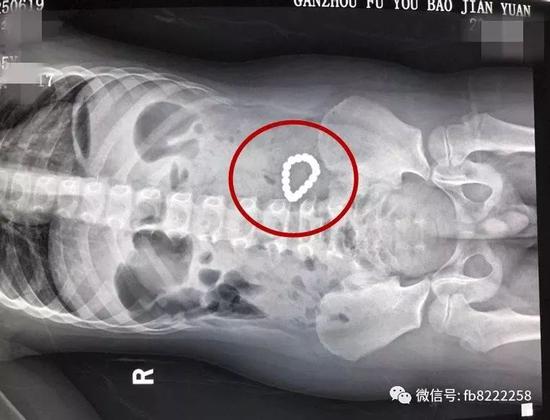 腹中磁铁相吸小肠多处穿孔