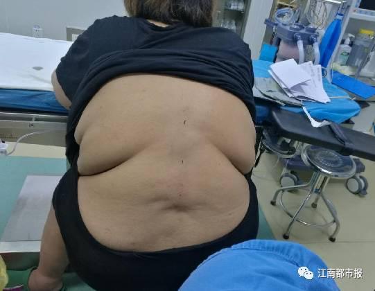 “这是我们医院接诊的体重最重的产妇,当时决定是自己生还是剖宫产,可真是个大难题! ”考虑到产道狭小,顺产的风险太大了。
