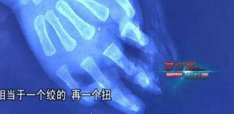断指情况异常复杂高难手术紧张进行