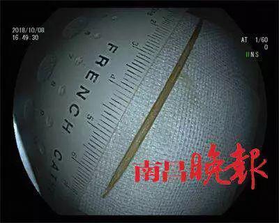 腹痛不止检查为胃息肉