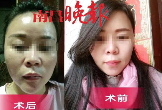 花6万做多项整容手术