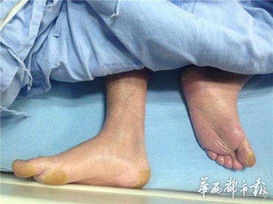 小陈的银屑病给他带去了极大痛苦。