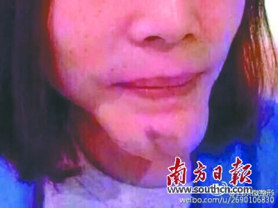 生长因子注射畸型患者。