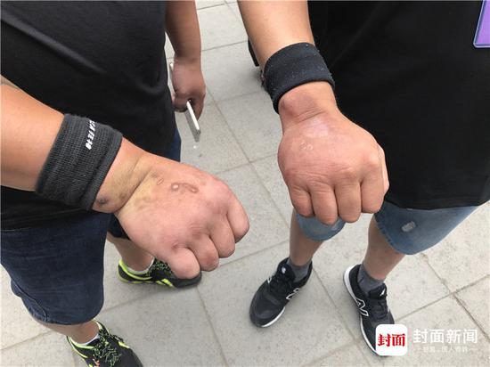 曹廷友徒弟练习铁砂掌后的手部。