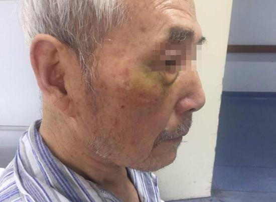 老人左手手臂骨折,右眼角等明显淤青。 澎湃新闻记者 陈斯斯 图