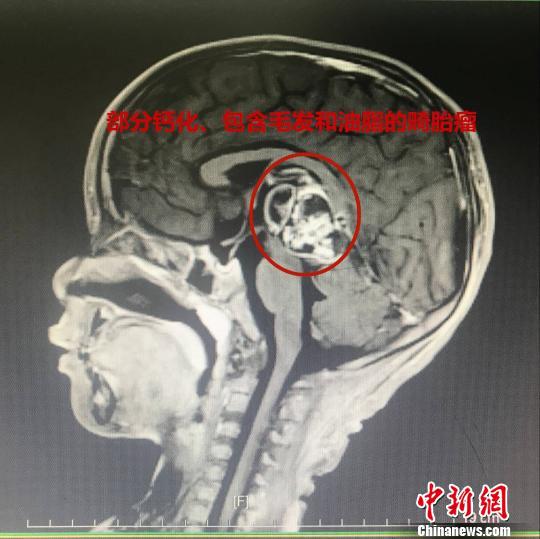 部分钙化、包含毛发和油脂的畸胎瘤　金静　摄