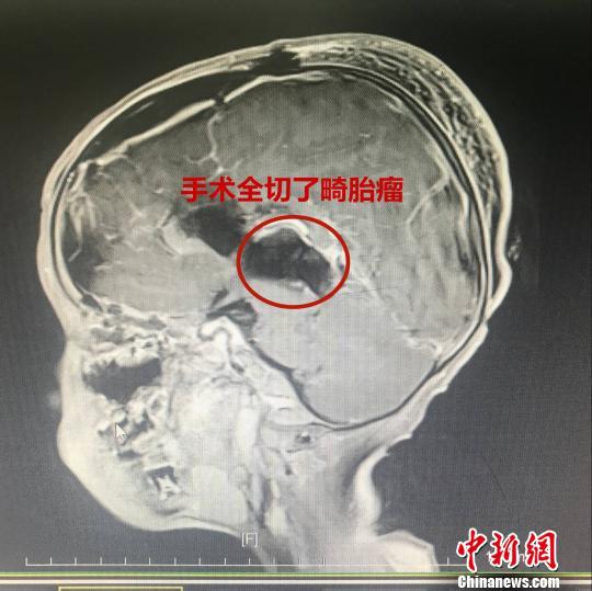 手术全切了畸胎瘤 金静 摄