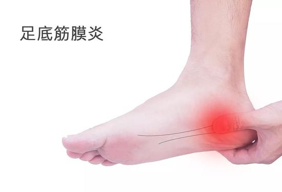 跑步脚跟钻心痛 原来都是足底筋膜炎惹的祸 跑步频道 新浪竞技风暴 新浪网