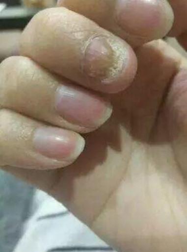 灰指甲怎样治疗有效呢 _hrF-fypyuvc9090018.jpg