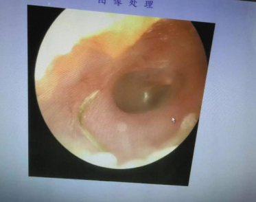 通过电子耳镜(放大)检查,医生发现了在张大姐耳道里捣乱的小绿虫。