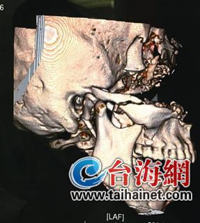 ▲患者受伤颅部的三维成像