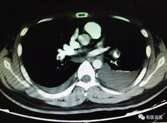 刚入院CT肺动脉造影，发现双肺动脉血栓堵塞