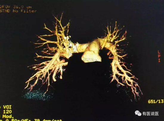 肺动脉造影三围成像可见右肺下叶两根血管截断，完全堵塞
