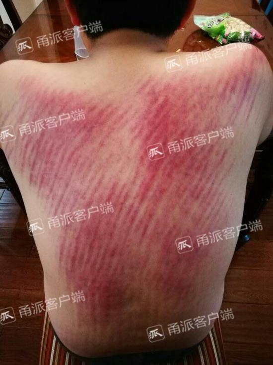 (危小虎受伤的背)