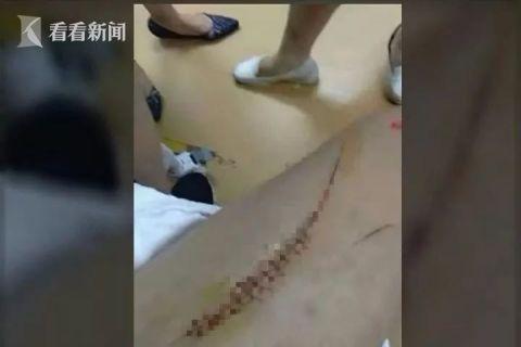 洗澡时玻璃门突然炸裂 祖孙俩酒店遭遇惊魂一幕