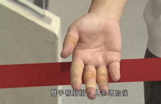 “火眼”是熬红了的双眼 援港检测队员重伤不下前线(图5) 有队员双手破皮 图源:无线新闻视频截图