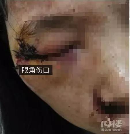 外卖员撞女子致其眼角破裂:就200块 撞死和我无关