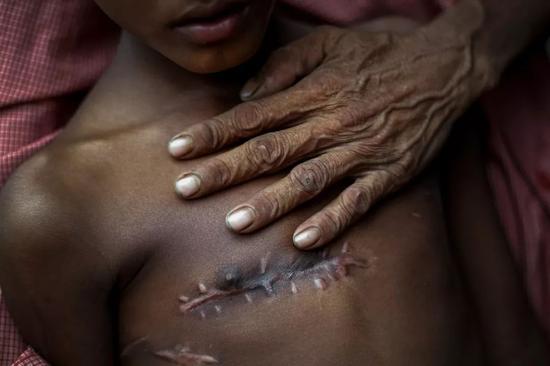 7岁的穆罕默德·沙伊布（Mohammed Shoaib）在从缅甸边境进入缅甸边境时胸部中弹。