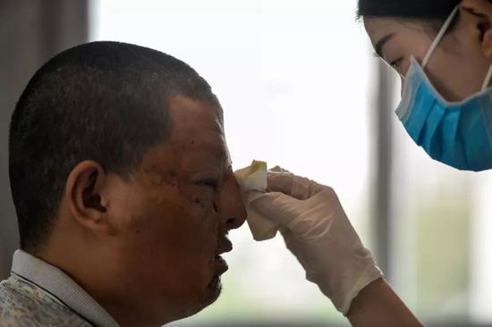 2018年9月11日武汉三医院烧伤科，护士为赵雪成擦拭面部。记者 胡冬冬  摄